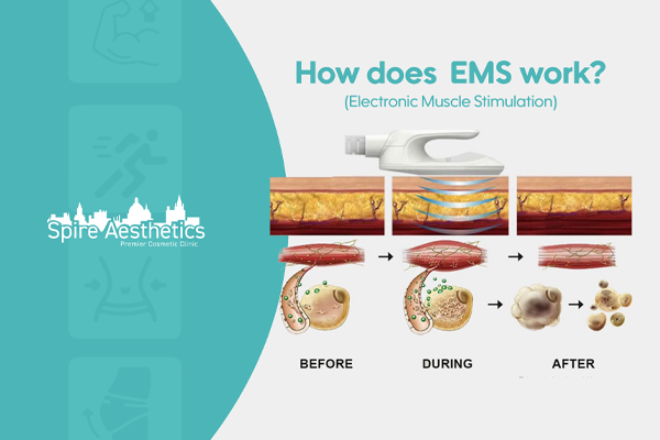 EMS treatment for post pregnancy weight loss treatment West Drayton