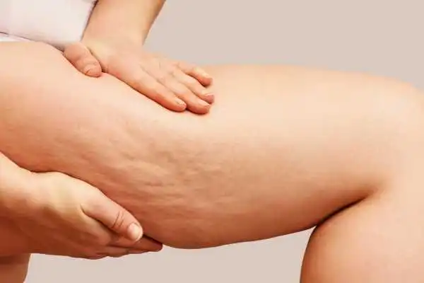 Image of woman showing leg with cellulite West Drayton
