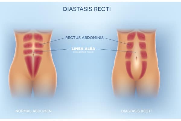 What Non-Surgical Options Are Available for Diastasis Recti West Drayton?
