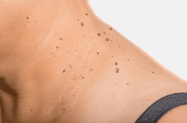 Are you looking for easy skin tag removal West Drayton - then contact Spire today!