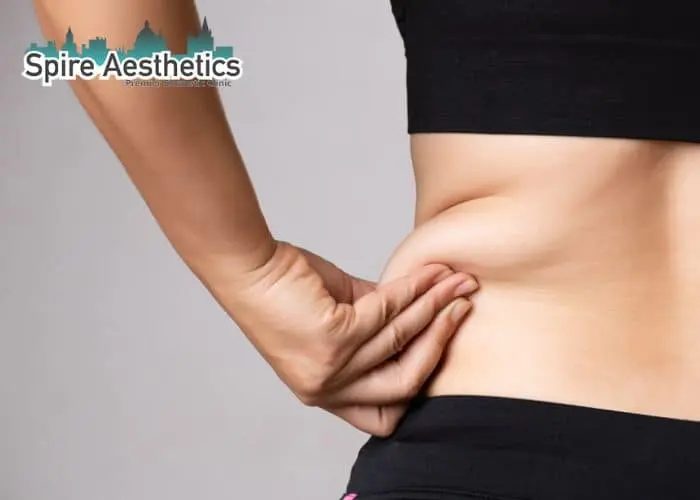 Image of woman pinching fat on their hips West Drayton. Fat Freezing treatment