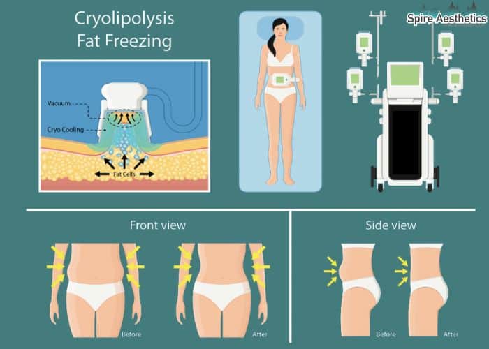 Image of diet and fat freezing combined for best results for Spire Aesthetics West Drayton