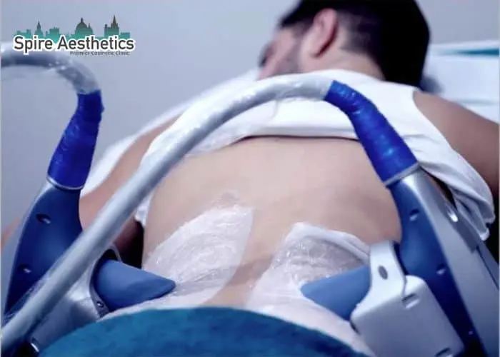 Man having fat freezing treatment done on love handles before a competitions West Drayton to create a sculpted look.