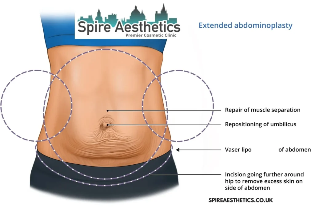 Understanding Loose Skin After Gastric Band West Drayton Surgery and HIFU Treatment