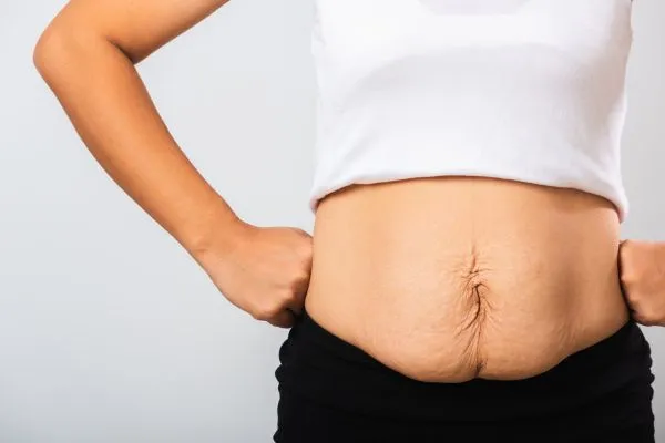 Image of a woman's stomach after weight loss with sagging skin following a gastric band West Drayton