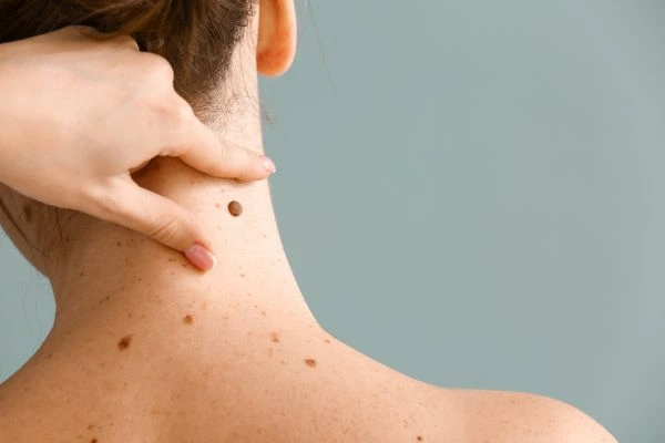 skin blemish removal West Drayton treatment
