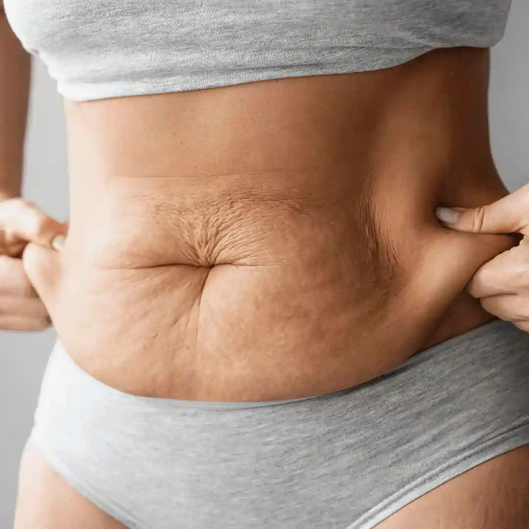 Is It Normal to Have Loose Skin After Pregnancy West Drayton?