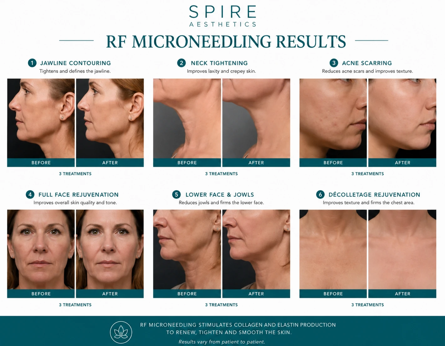 RF Microneedling Skin tightening West Drayton results