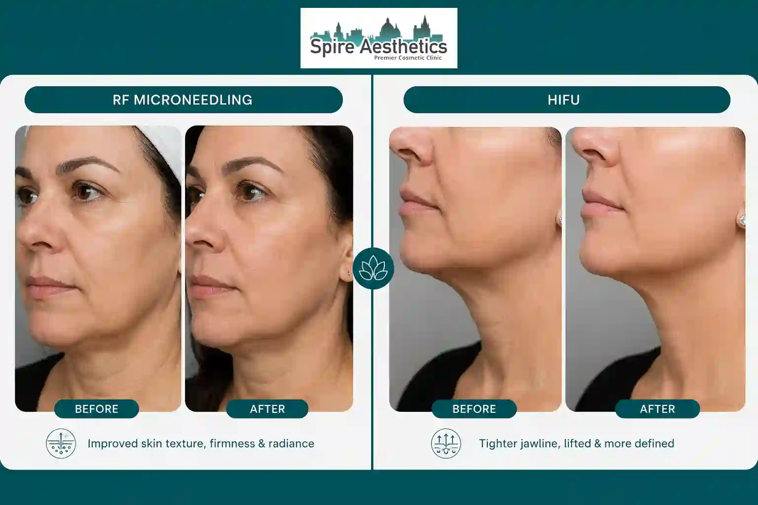 Can RF Microneedling and HIFU Be Combined West Drayton?