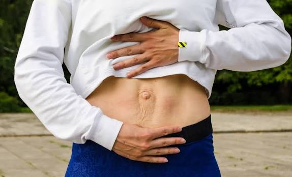 When Could Diastasis Recti Be the Missing Piece of the Puzzle West Drayton?
