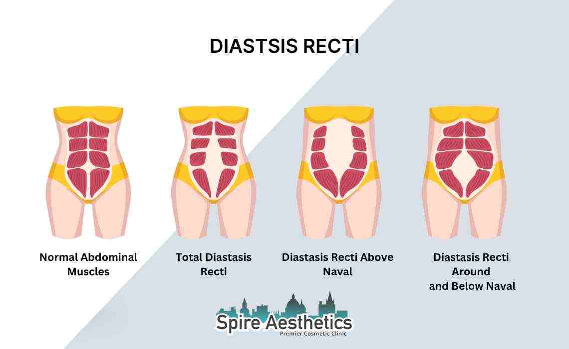 Is Non-Surgical Diastasis Recti Treatment Right for You? Common Concerns Answered West Drayton